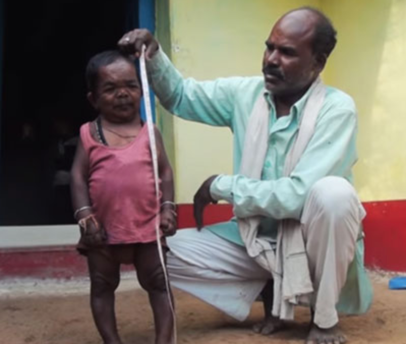 世界仰天ニュース！インドのバソーリ・ラルは身長73センチのおじちゃん！病気の原因や画像は？